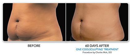 Side-by-side comparison of a torso before and after CoolSculpting treatment, showing reduced fat.