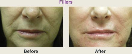 Before and after comparison of lip wrinkles treated with fillers.