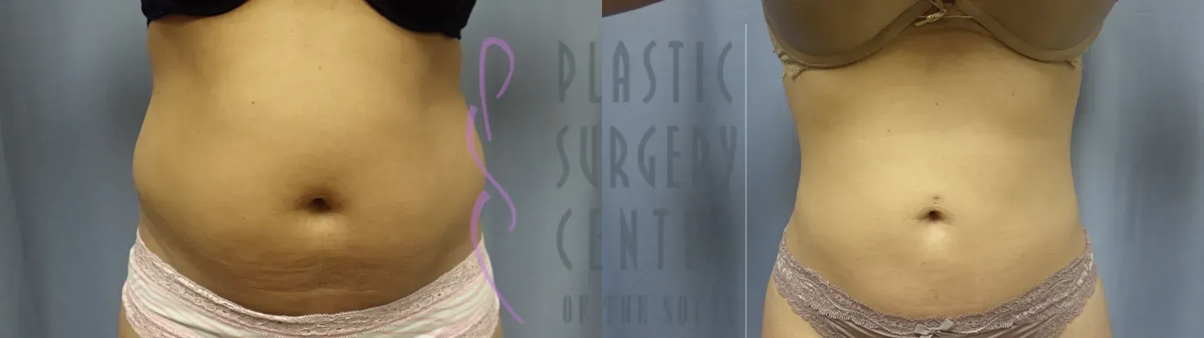 Before and after view of a person's abdomen, showing a visible reduction in abdominal circumference.