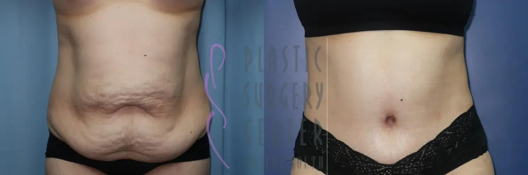 Before and after abdominal surgery. Flabby stomach before and toned abdomen after.