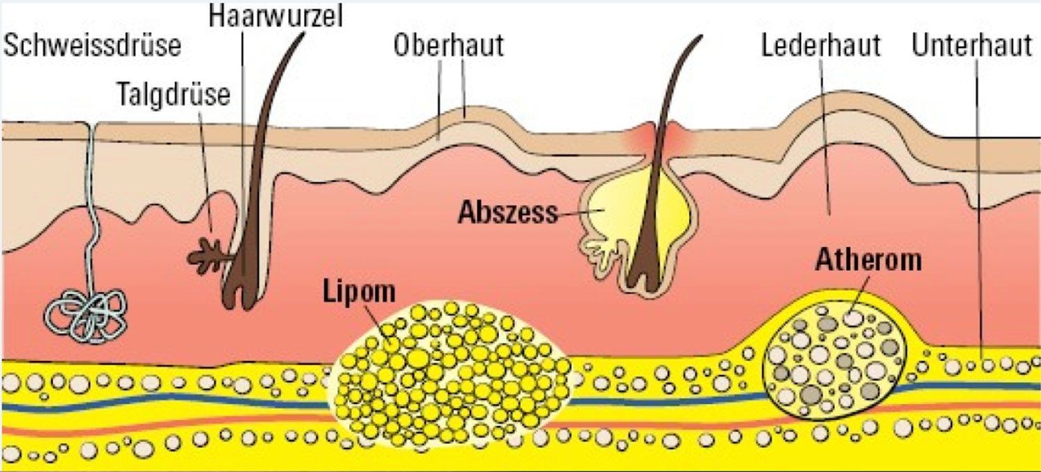 Lipom