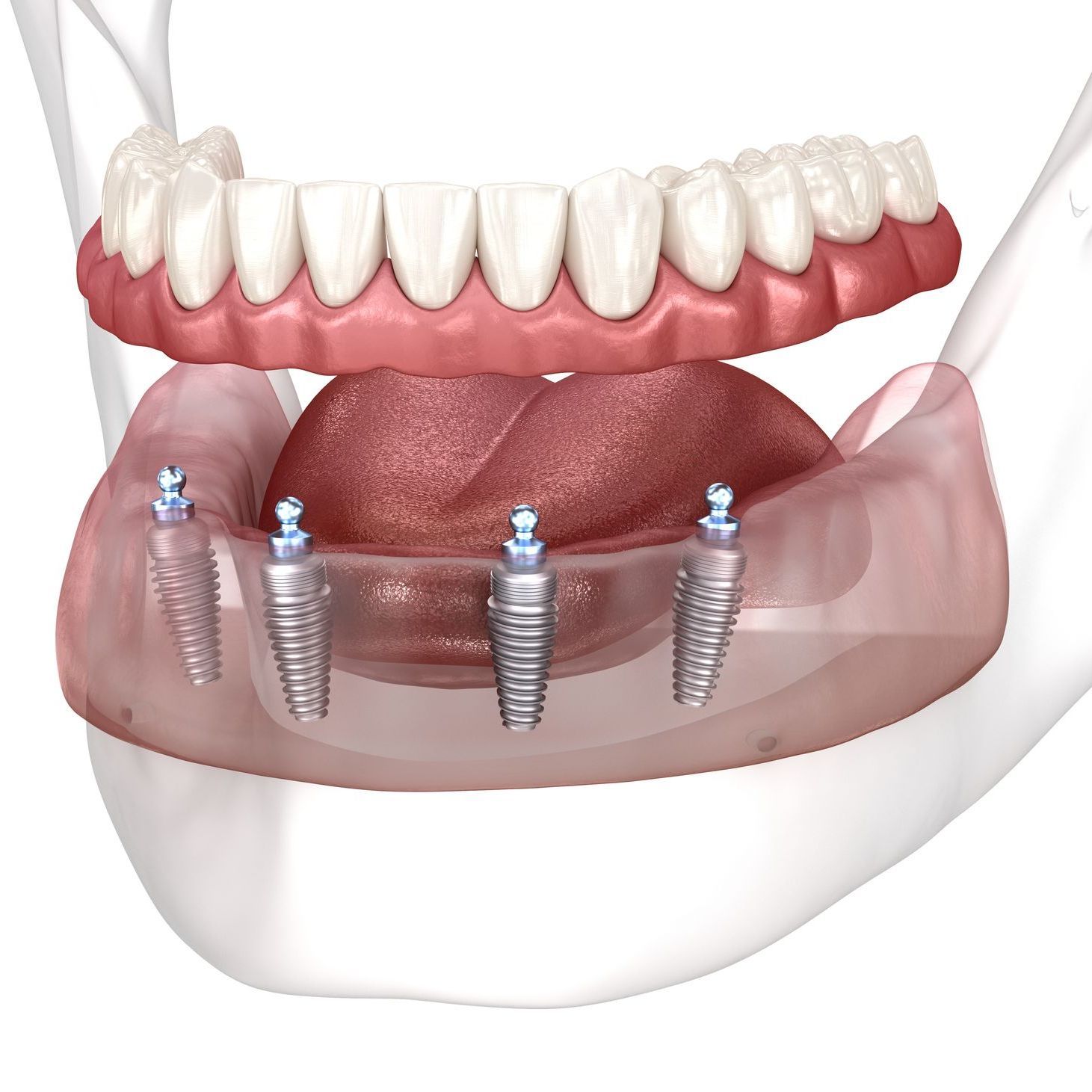 A computer generated image of a bottom jaw full arch implant