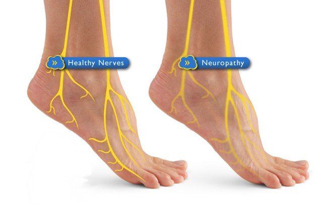 Nerve Damage In Foot