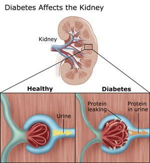 Diabetes Affects the Kidneys