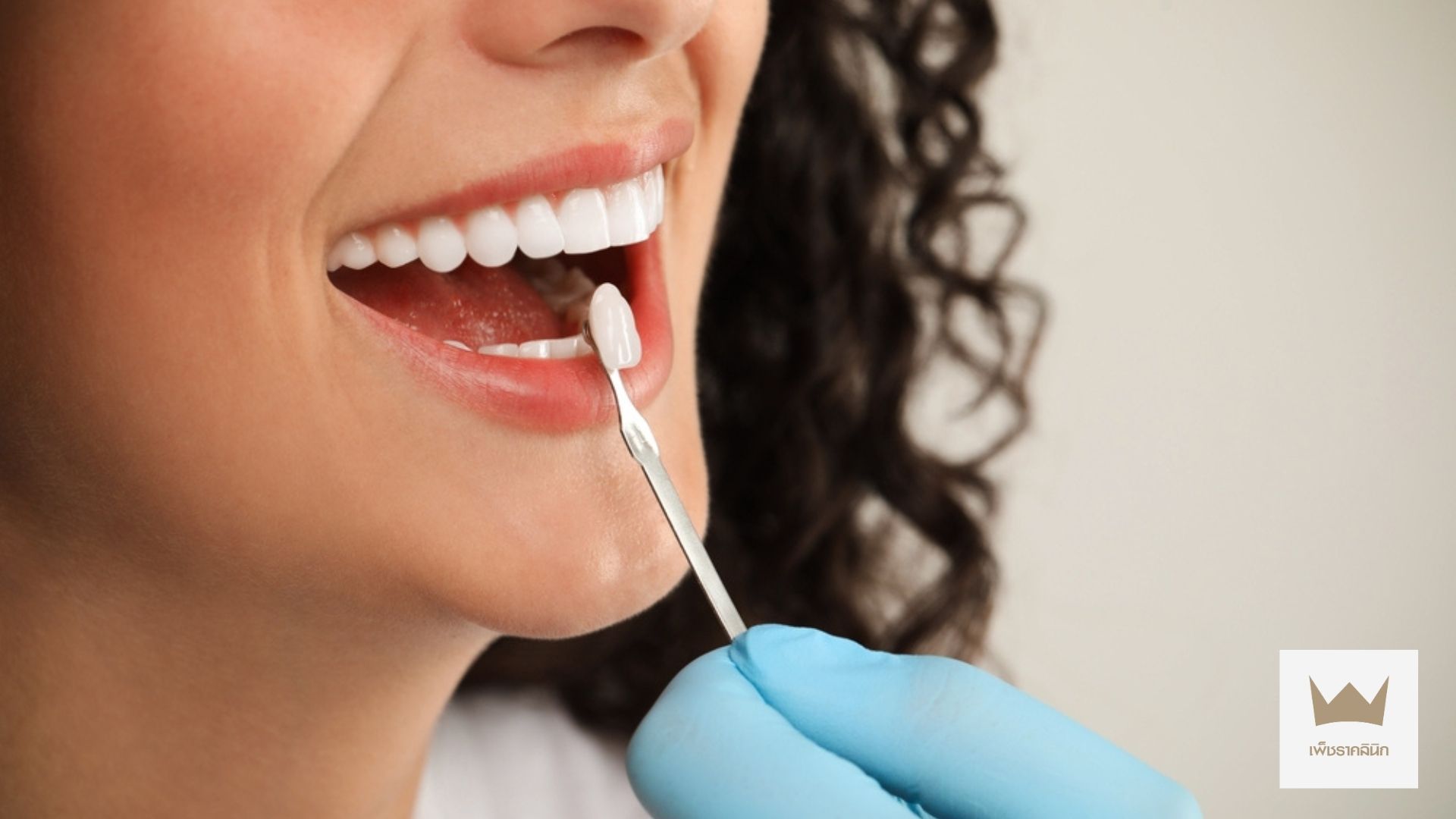 Why get veneers? 5 reasons that will make you smile confidently