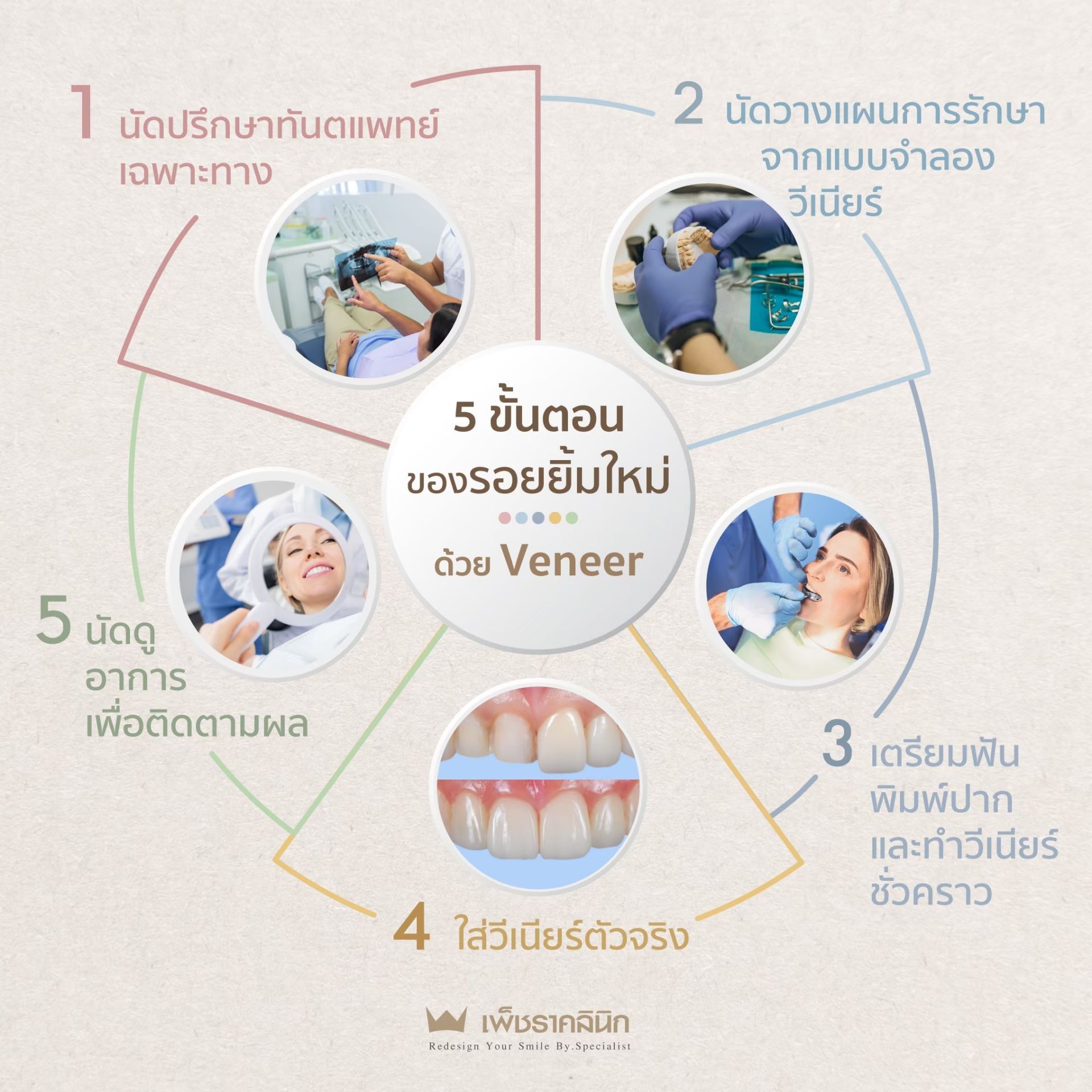 how-to-get-veneers-perfect-smile