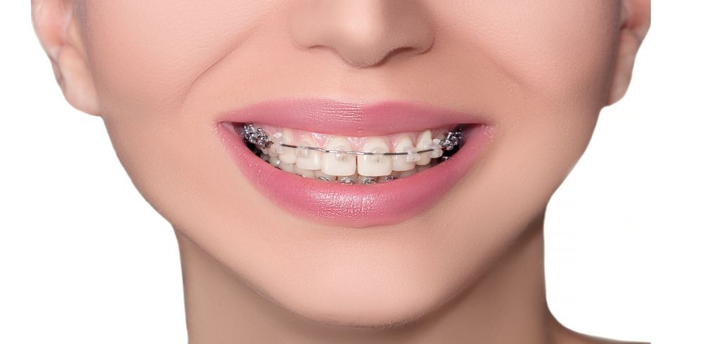 phetcharaclinic-pain-after-braces