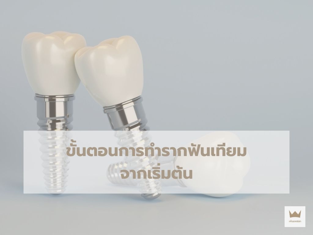 การทำรากฟันเทียม ถือเป็นทางเลือกที่ได้รับความนิยมอย่างแพร่หลายในการทดแทนฟันที่สูญเสียไป เ