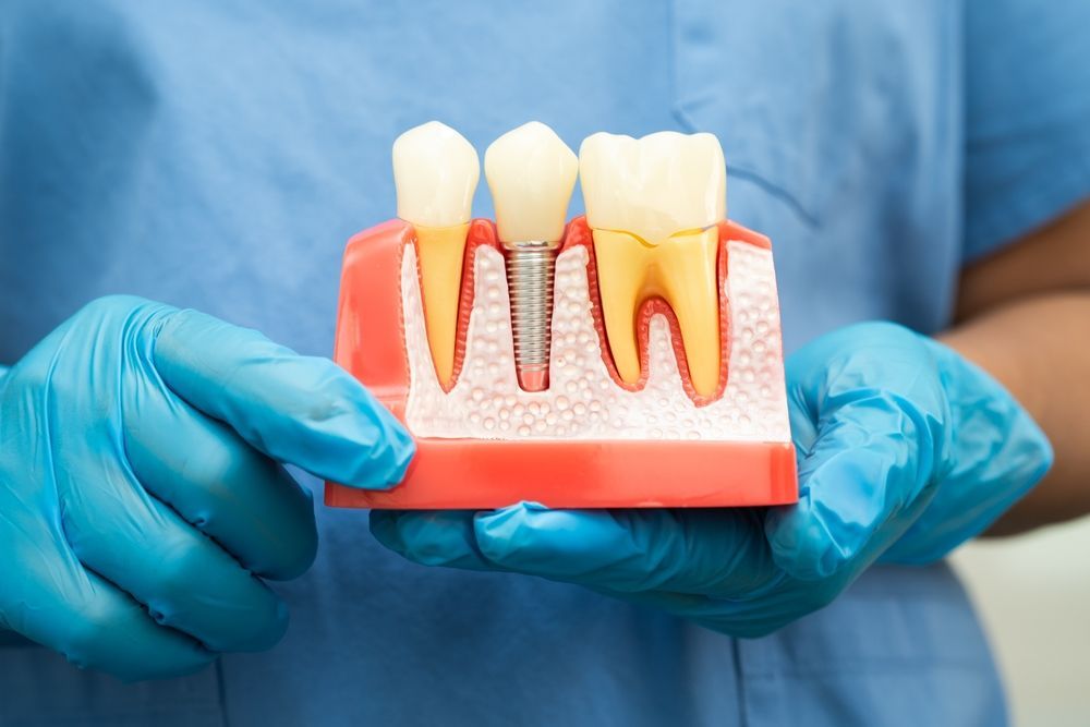 dental-implant-bad-breath