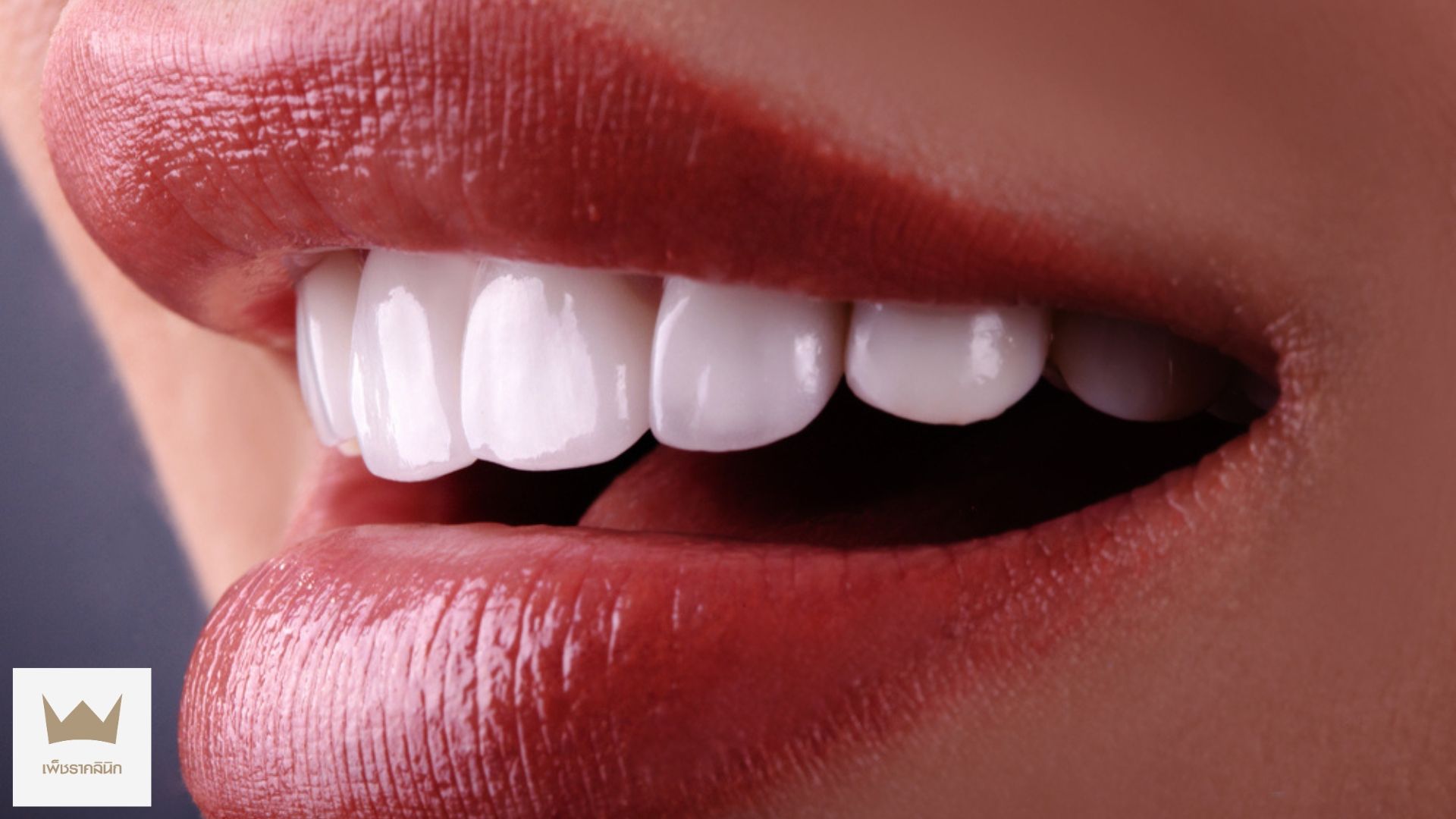 ขั้นตอนการทำวีเนียร์แบบละเอียด ออกแบบรอยยิ้มอย่างเป็นธรรมชาติ
