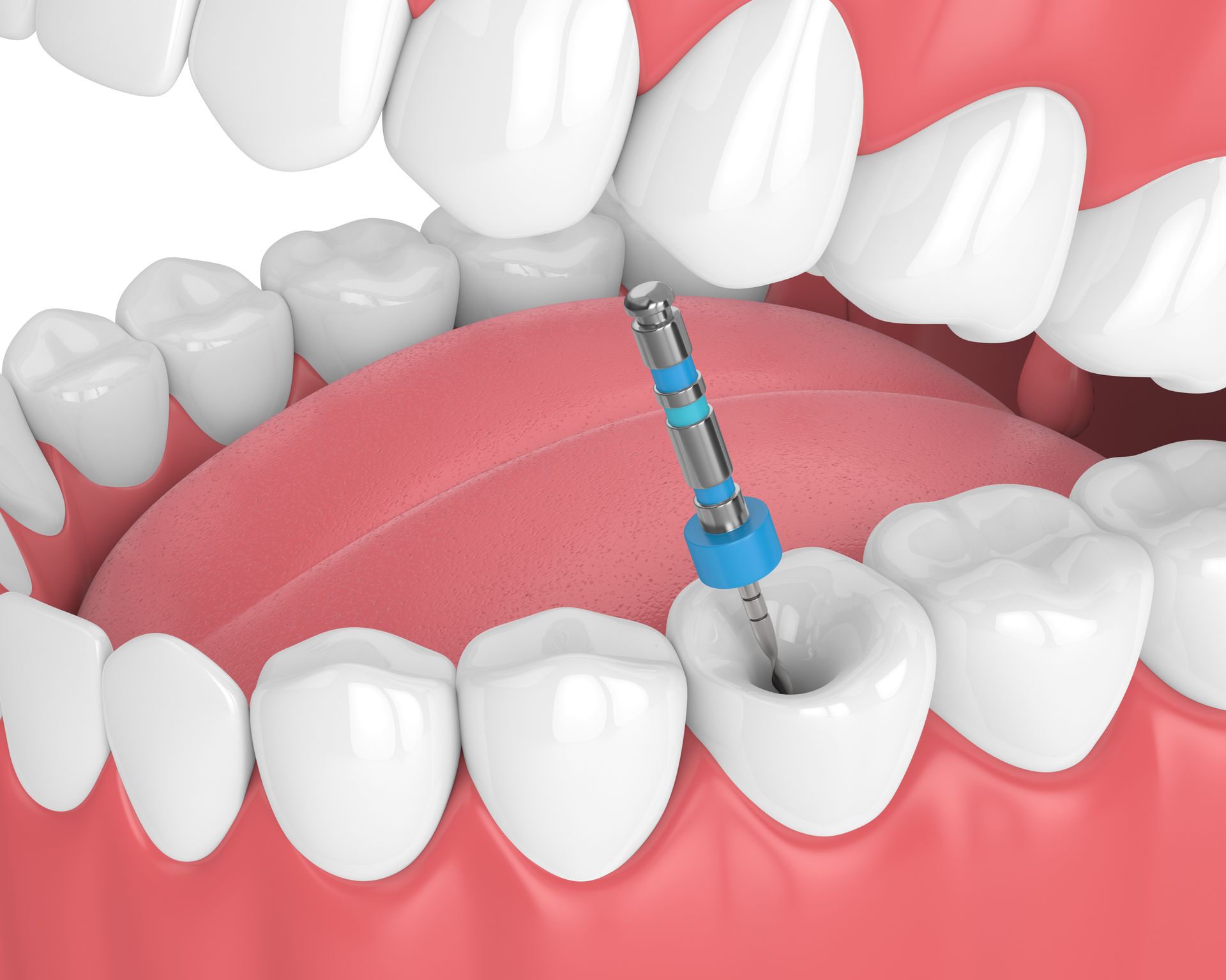 post-root-canal-care-diet-guide