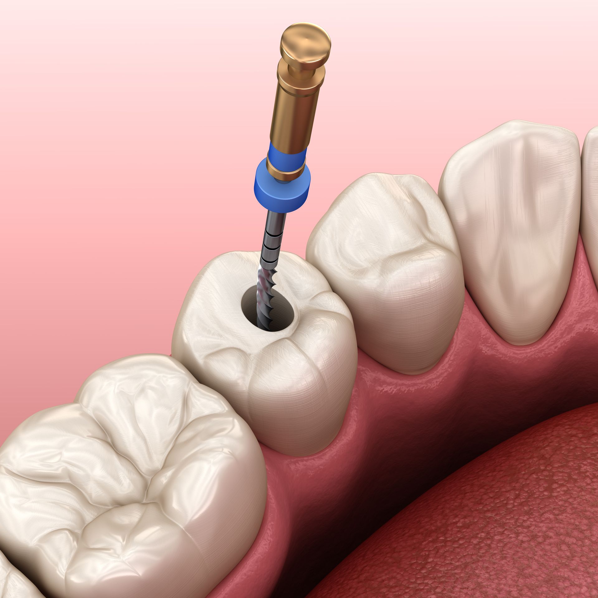root-canal-causes-treatments