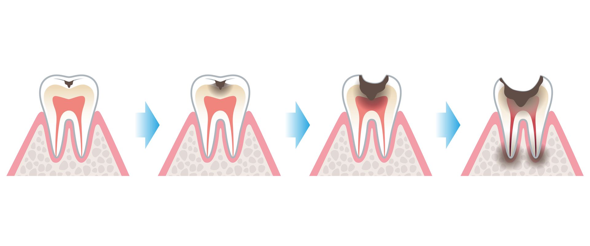 tooth-decay-stages-root-canal