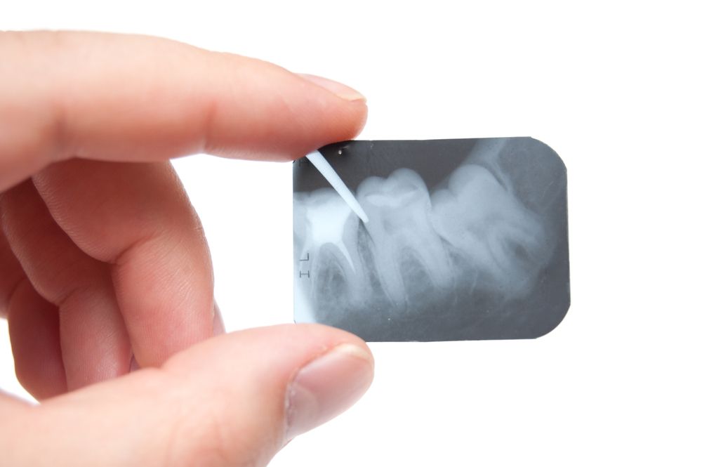 braces-wisdom-teeth