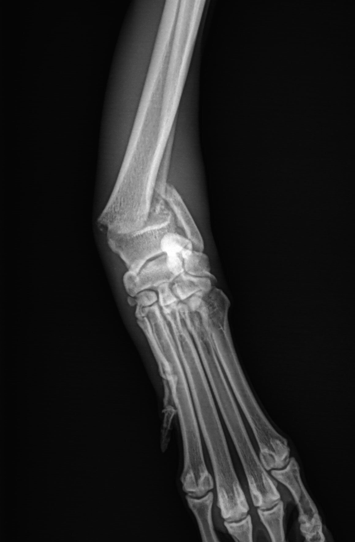 AAH fractured radius at growth plate