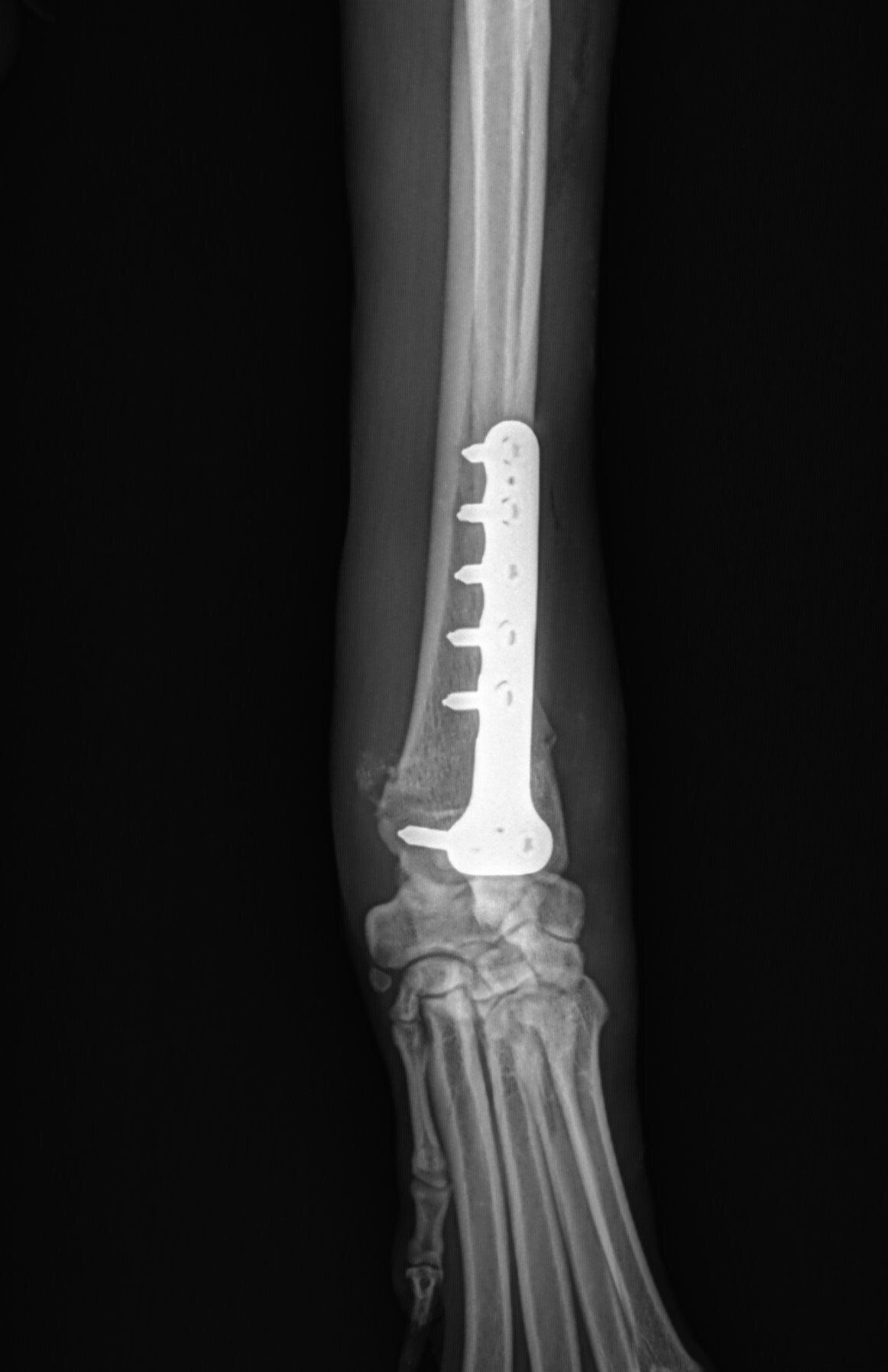 AAH fractured radius at growth plate