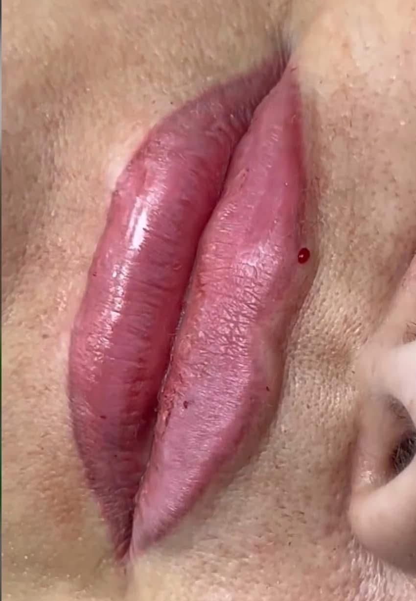 Lip filler treatment