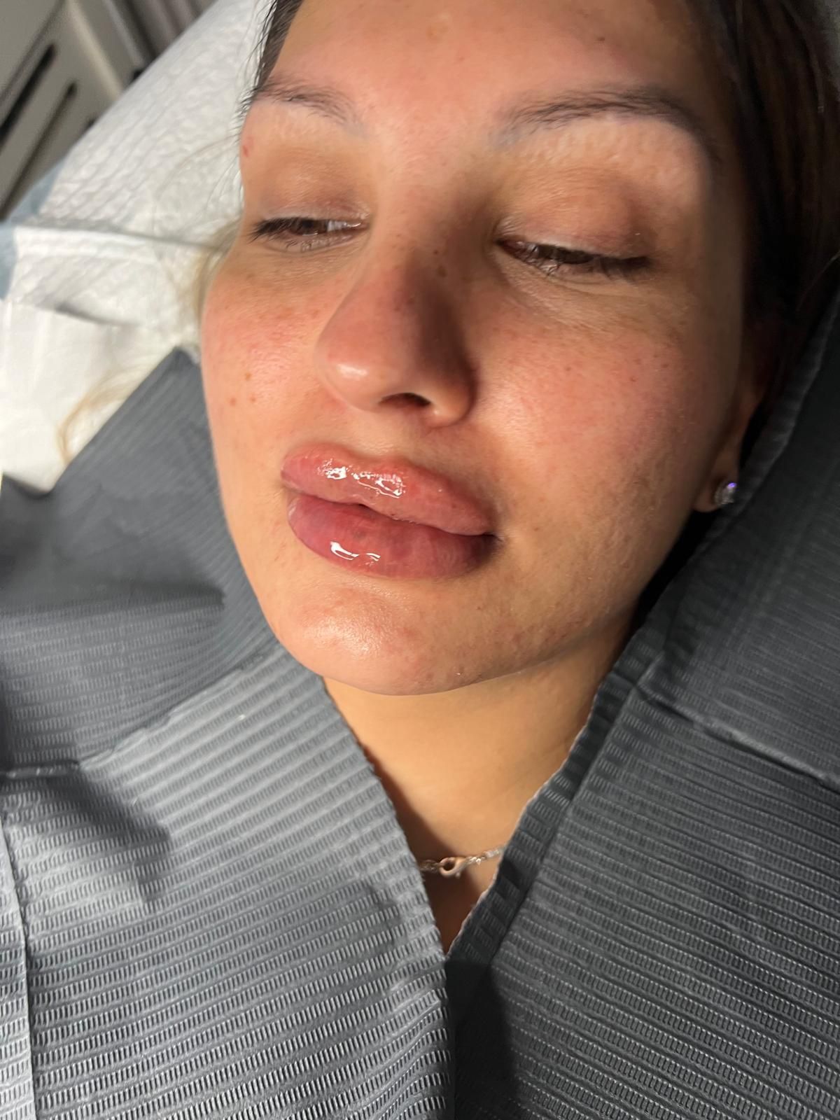 Model having fillers