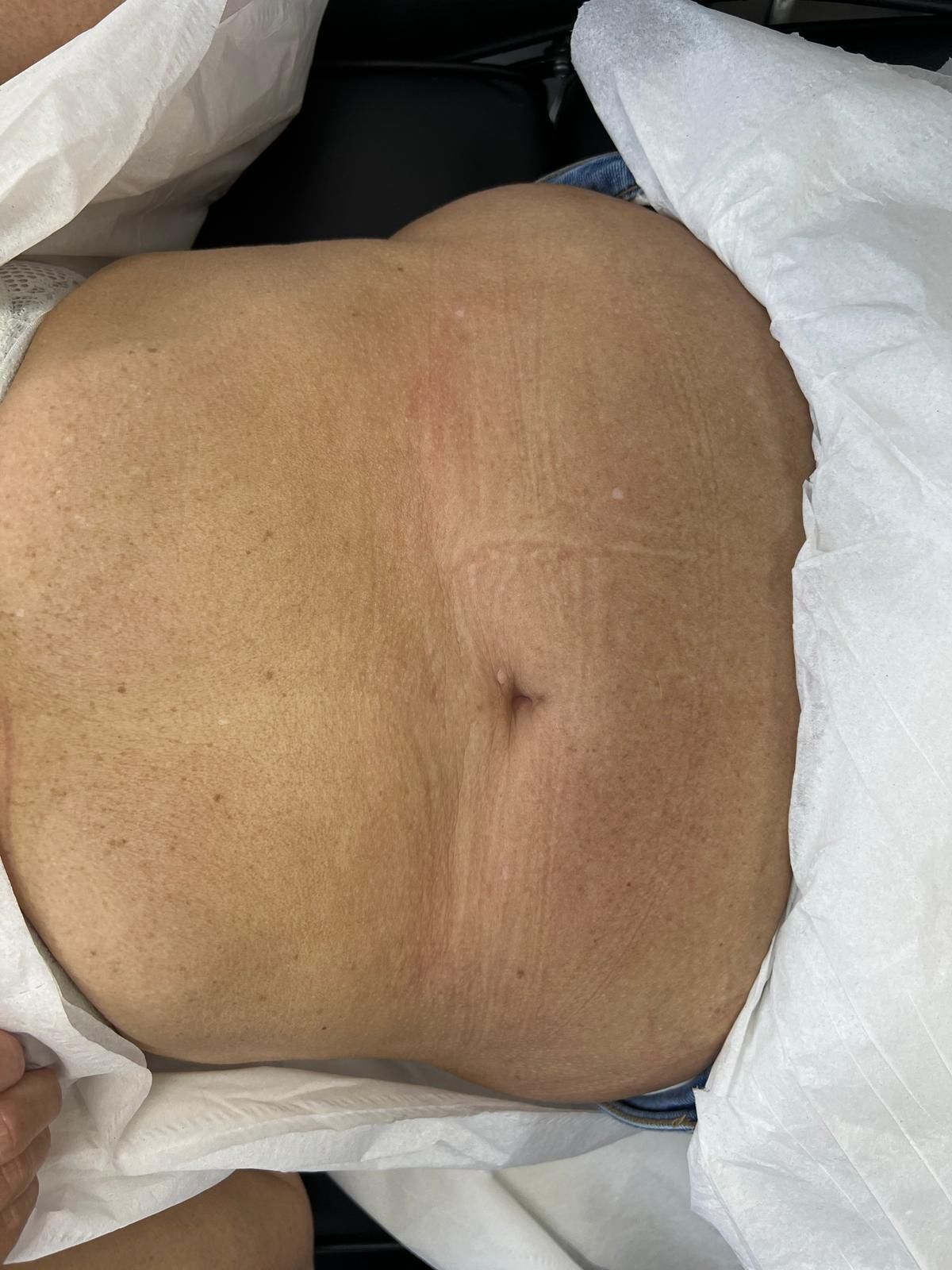 Aesthetic treatment on the stomach