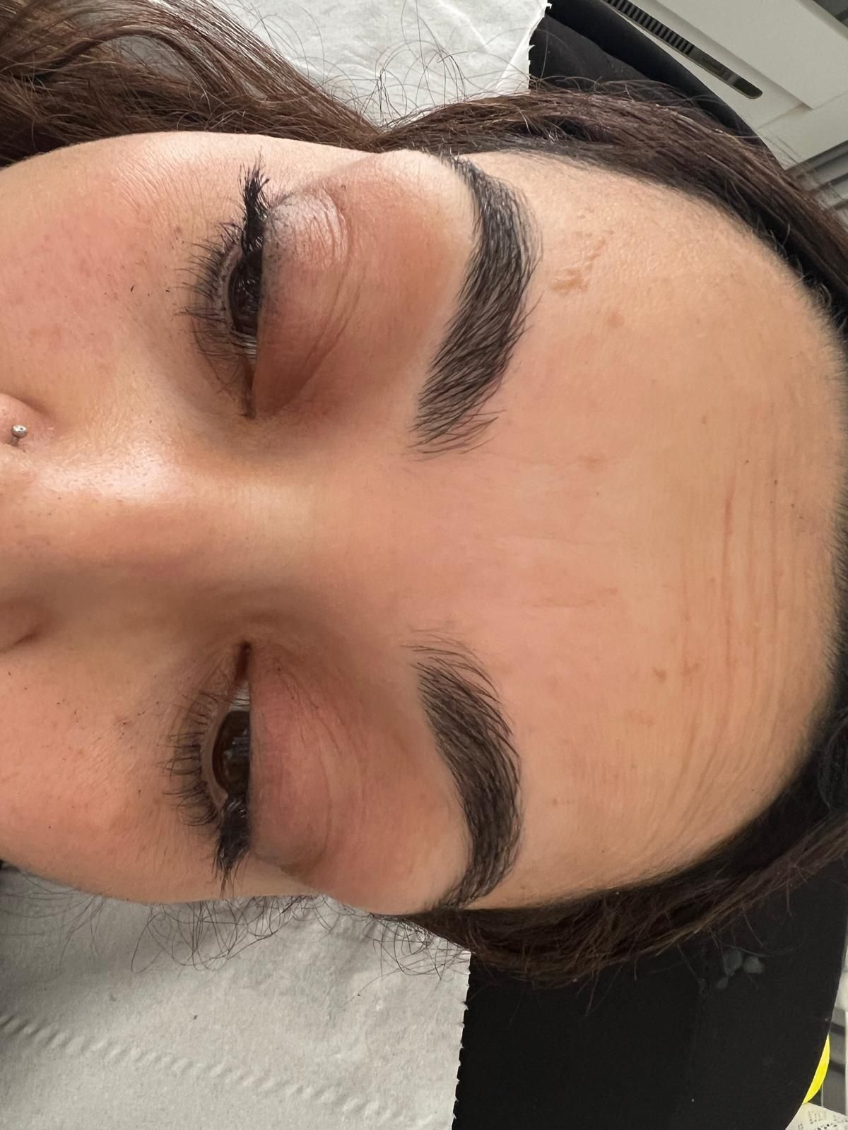 After Aesthetic treatment on the forehead