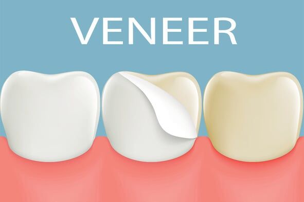 Teeth Whitening — teeth whitening in Schererville, IN