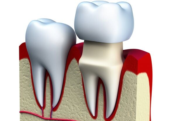 Dental Crowns - Saint John, IN - Indiana Implants & Dentistry