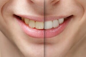 Man Smile Before and After Teeth Whitening - Teeth Whitening in Schererville, IN