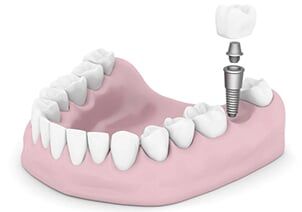 Teeth Implant — implants in Schererville, IN