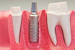 Dental Implant Model - Restorative Dentistry in Schererville, IN