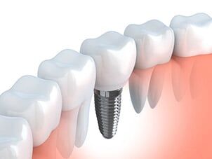 Implanted Tooth — dental implants in Schererville, IN