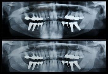 Dental X-Rays - Schererville, IN - NWI Center