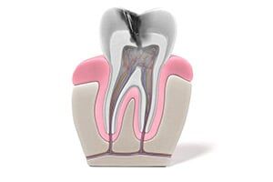 An illustration of a tooth in need of emergency dentistry services near St. John, IN