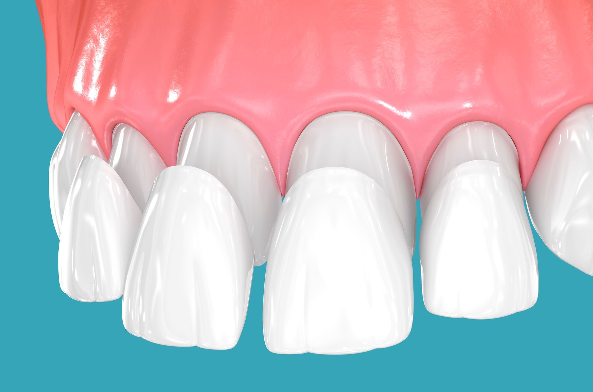 Dental veneers on blue background.