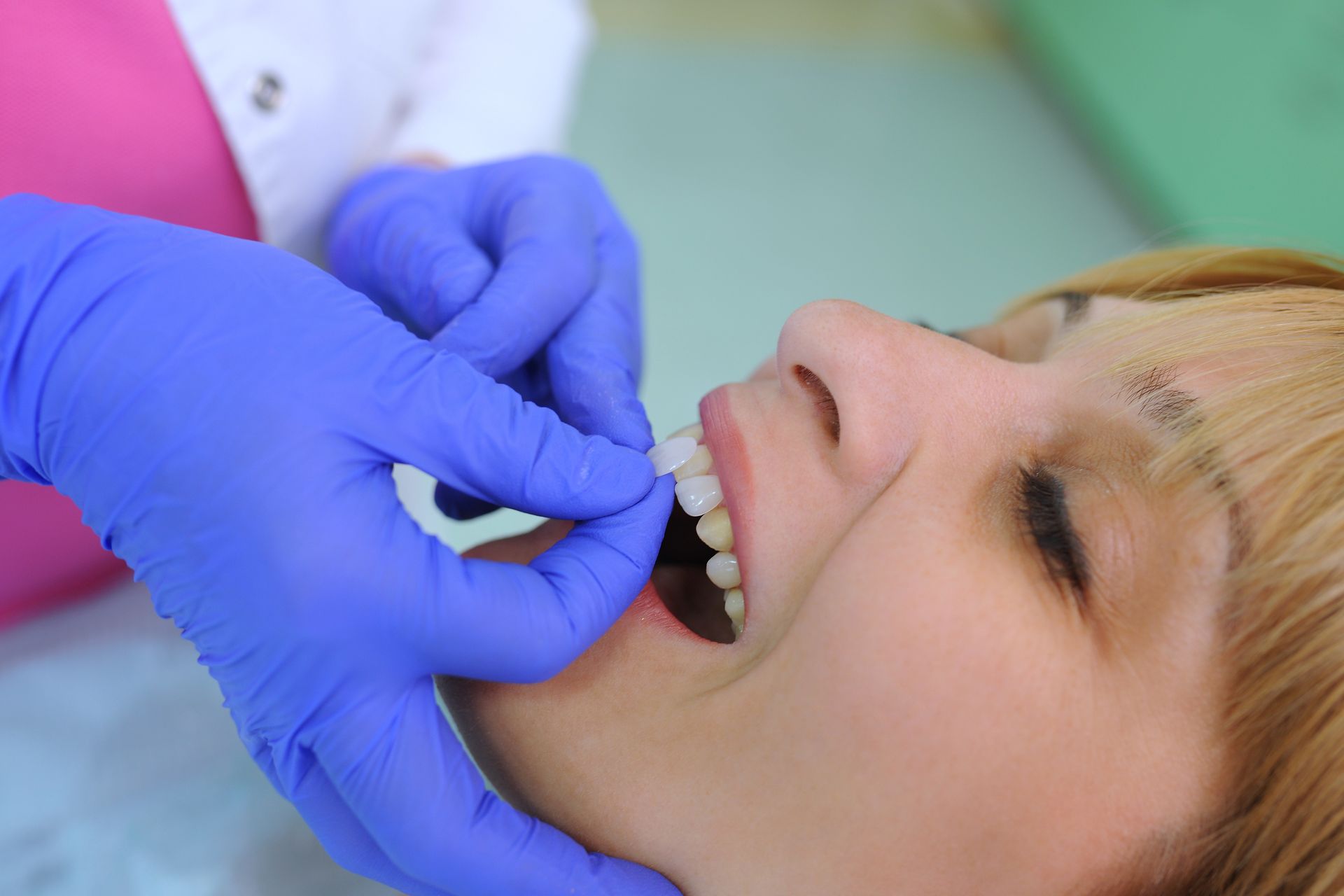 Close-up of a dentist placing dental veneers on a patient and correcting their teeth.