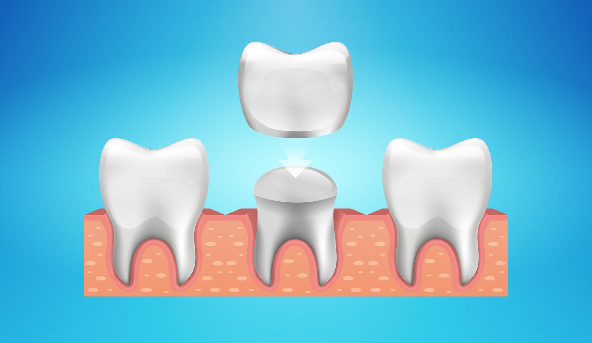 Dental Crowns - Crown Point, IN - Indiana Implants & Dentistry