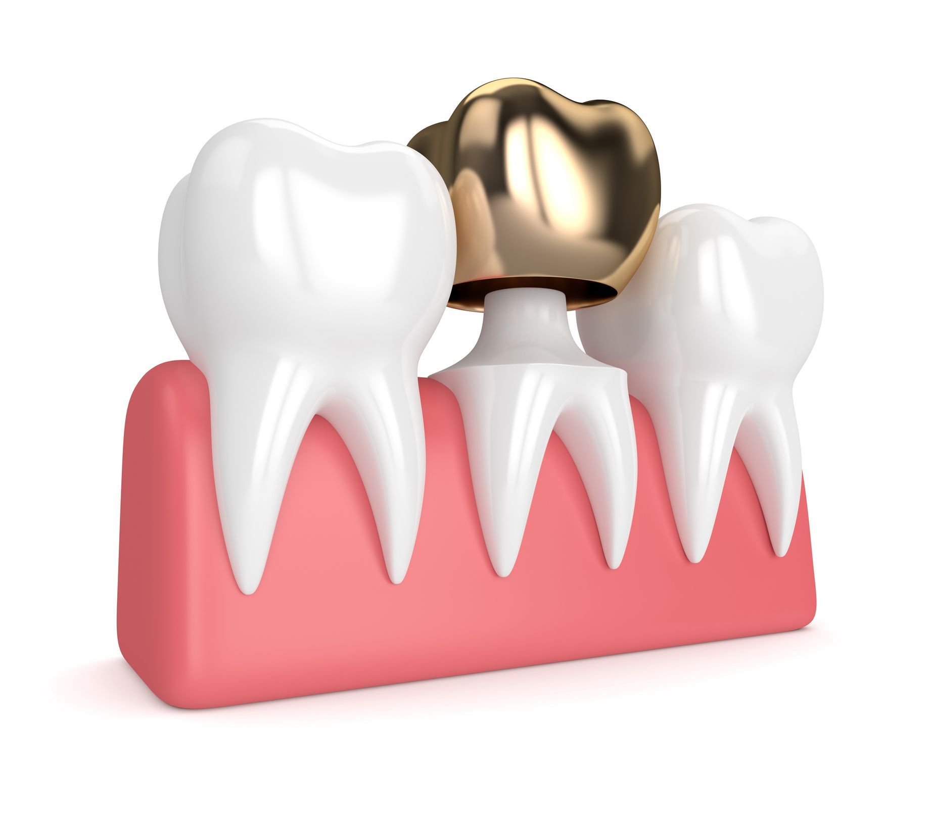 Dental Crowns - Dyer, IN - Indiana Implants & Dentistry