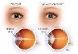 what are cataract - cataract surgery in Middletown, RI