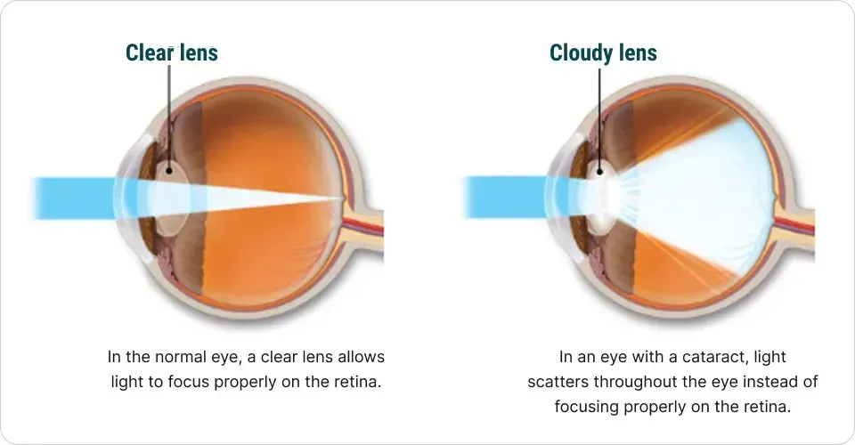 what are cataract - cataract surgery in Middletown, RI
