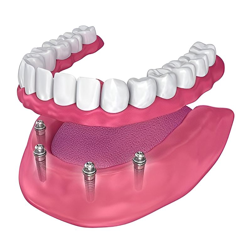 A Full Denture With Dental Implants — Central Coast Denture Clinic Erina In Erina, NSW