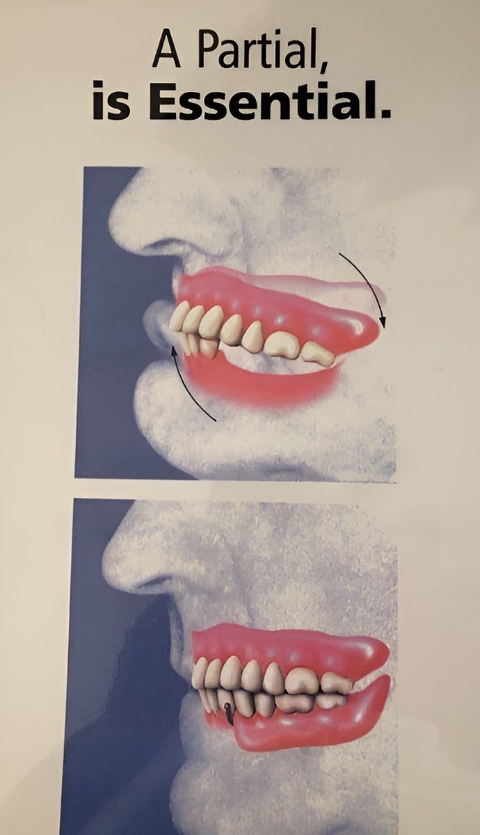 A Mouth With and Without Partial Dentures — Central Coast Denture Clinic Erina In Erina, NSW