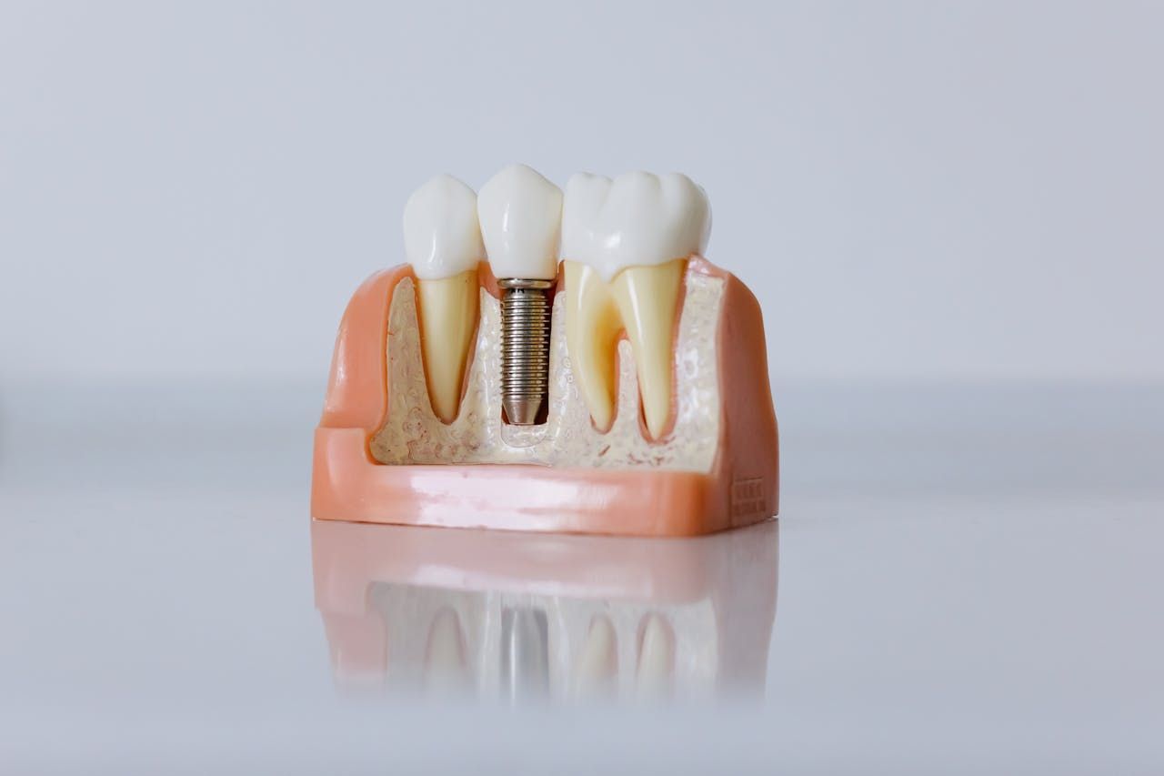 Model of a tooth implant with a crown, next to two healthy teeth in a pink gum model on a white surface.  — Central Coast Denture Clinic Erina In Erina, NSW