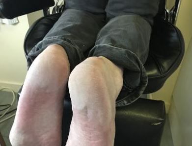 cracked heels after treatment