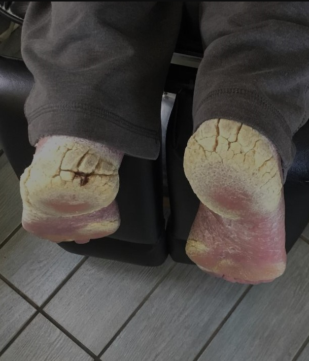 A patient with severe callus