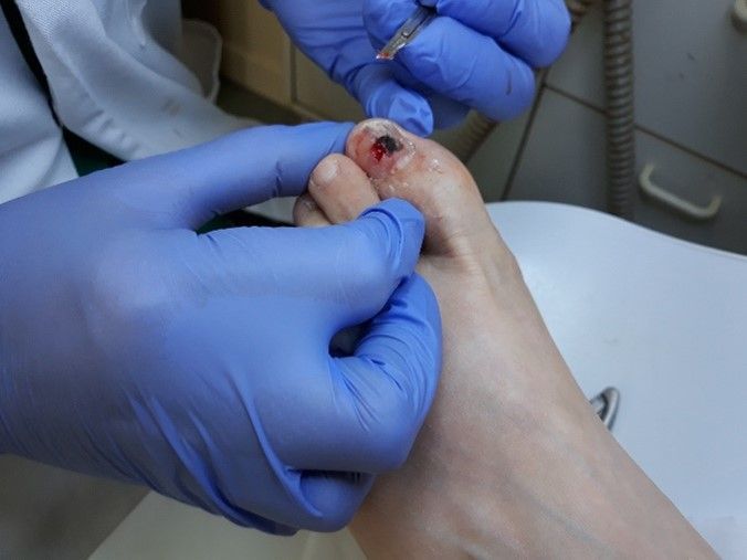 A patient with a severely damaged nail and a large subungal pus sac; before, during and after treatment