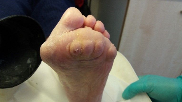 Patients with rheumatoid feet afforded relief from discomfort and ulceration by ongoing padding techniques.