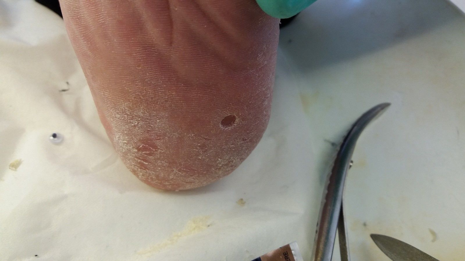 A Patient with a  foreign object embedded