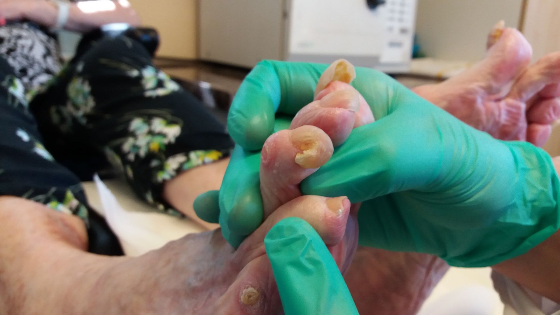 corns and damaged curled nails