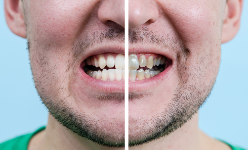 A man with a beard is shown before and after whitening his teeth.