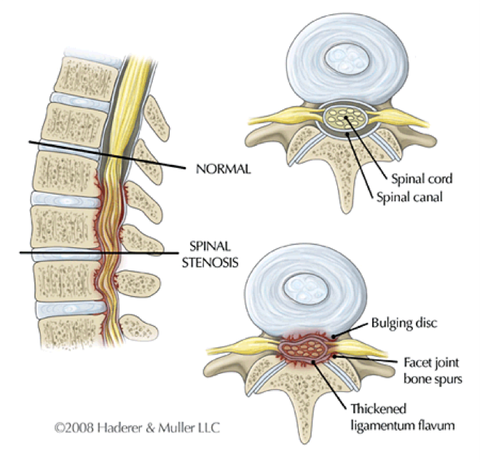 Spinal Stenosis Treatment in Alpharetta, GA (Atlanta Area)