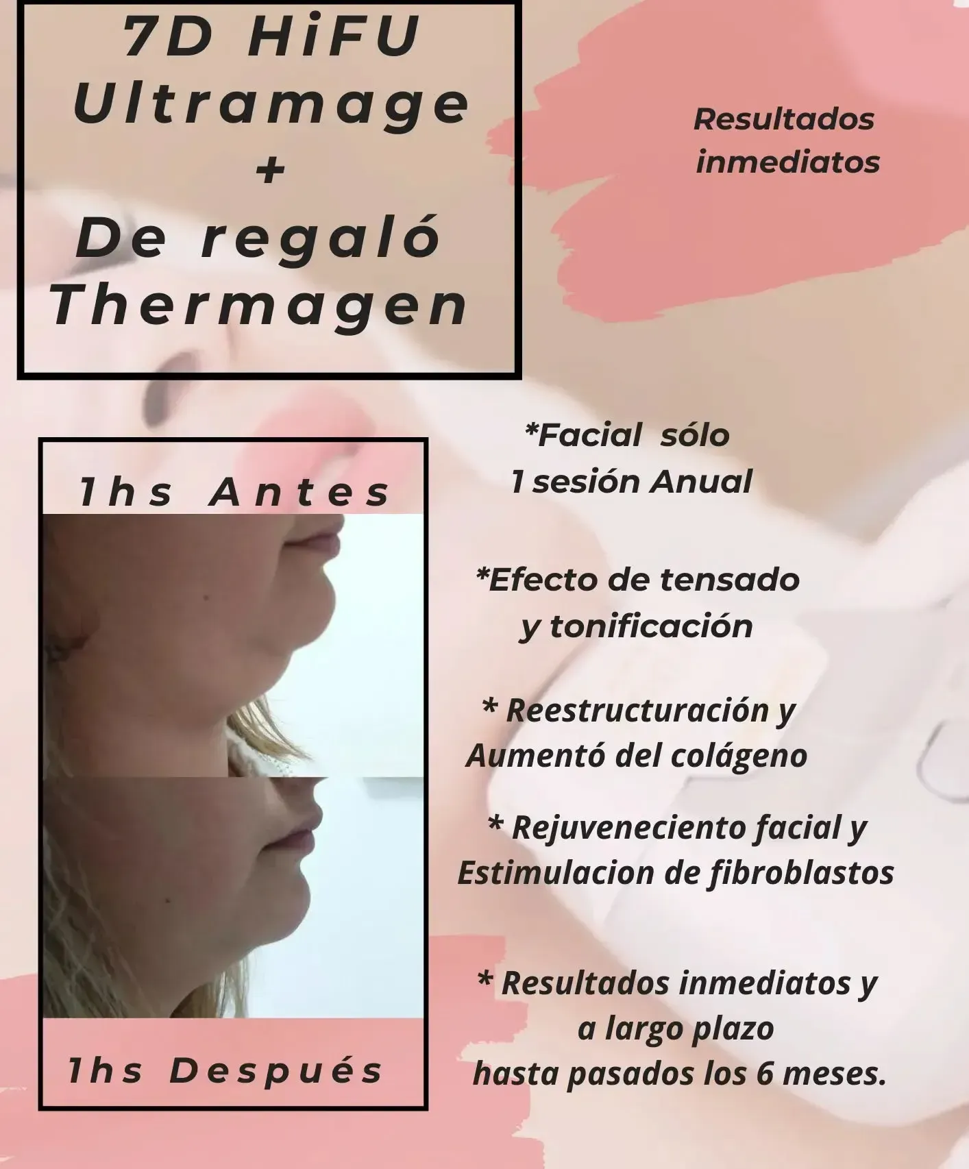 Folleto promocional: 7D HIFU Ultramage y Thermagen. La foto de la mandíbula, antes y después